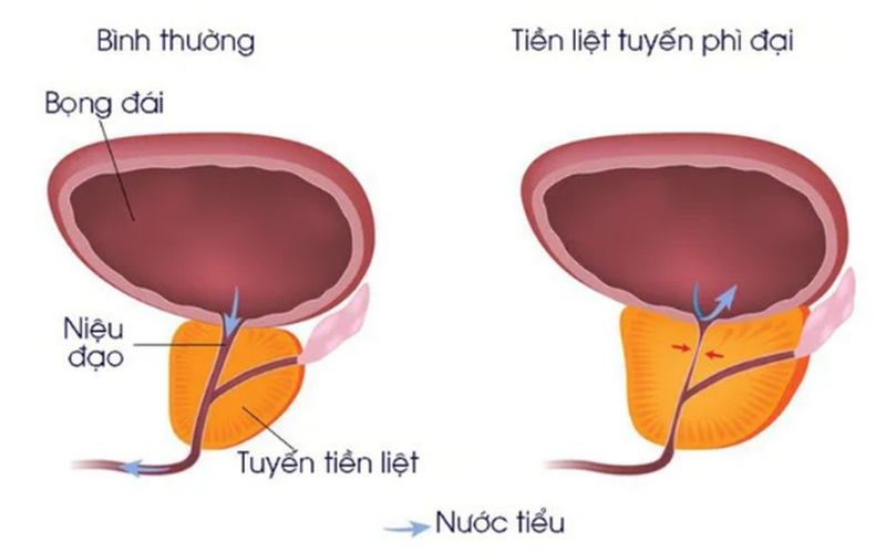 cac benh thuong gap o tuyen tien liet