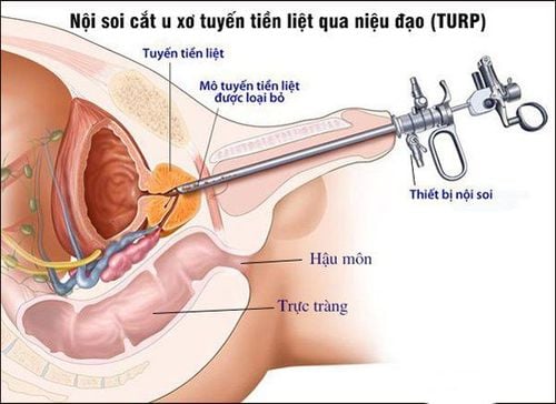 kich thuoc tuyen tien liet bao nhieu thi phai mo