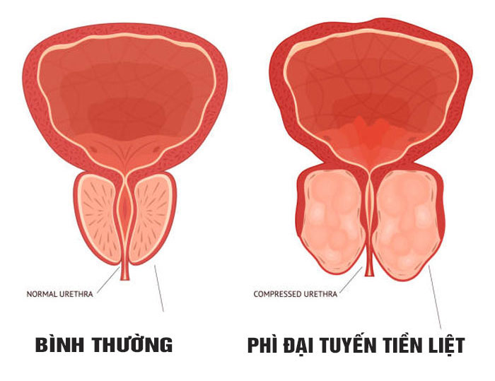 trieu chung thuong gap cua pho dai tien liet tuyen