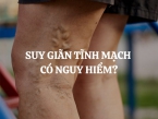 Bệnh suy giãn tĩnh mạch có nguy hiểm không? Để lâu có sao không?