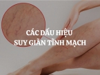 Các dấu hiệu suy giãn tĩnh mạch và phương pháp điều trị hiệu quả nhất