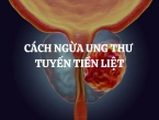 Cách ngừa ung thư tuyến tiền liệt: Hướng dẫn chi tiết và hiệu quả