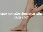 Giảm suy giãn tĩnh mạch bằng cách nào? Nguyên nhân gây suy giãn tĩnh mạch