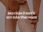 Nguyên nhân gây đau chân ở người suy giãn tĩnh mạch