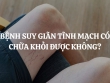 Bệnh suy giãn tĩnh mạch có chữa khỏi được không? Cách ngừa suy giãn tĩnh mạch