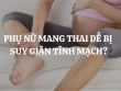 Tại sao phụ nữ mang thai dễ bị suy giãn tĩnh mạch? Cách phòng ngừa hiệu quả nhất là gì?