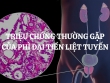 Triệu chứng thường gặp của phì đại tiền liệt tuyến là gì? Cách cải thiện tình trạng phì đại tuyến tiền liệt